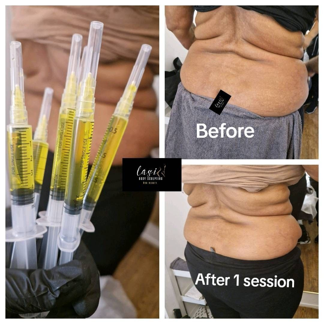 before and after fat dissolving injection images